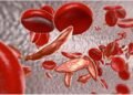Sickle Cell Disease