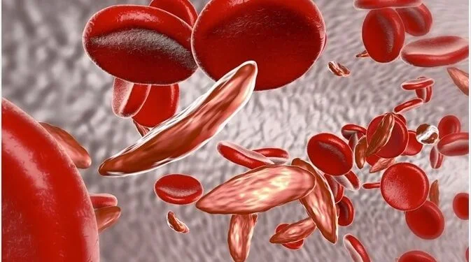 Sickle Cell Disease | International Khabar Sickle Cell Disease